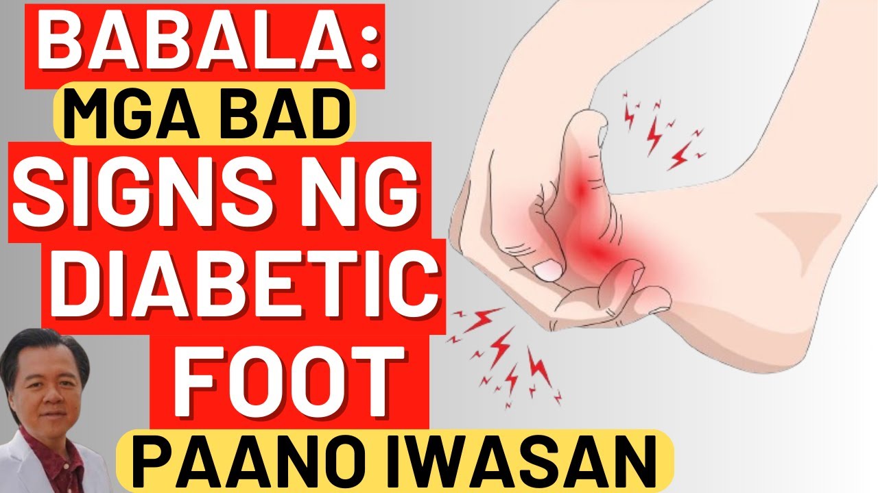 Babala: Mga Bad Signs ng Diabetic Foot. - By Doc Willie Ong (Internist and Cardiologist)