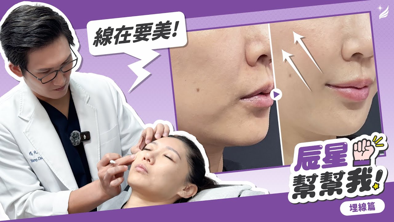【埋線臨床案例】模特兒自信的起點—從輪廓拉提開始｜皮膚專科楊兆傑醫師