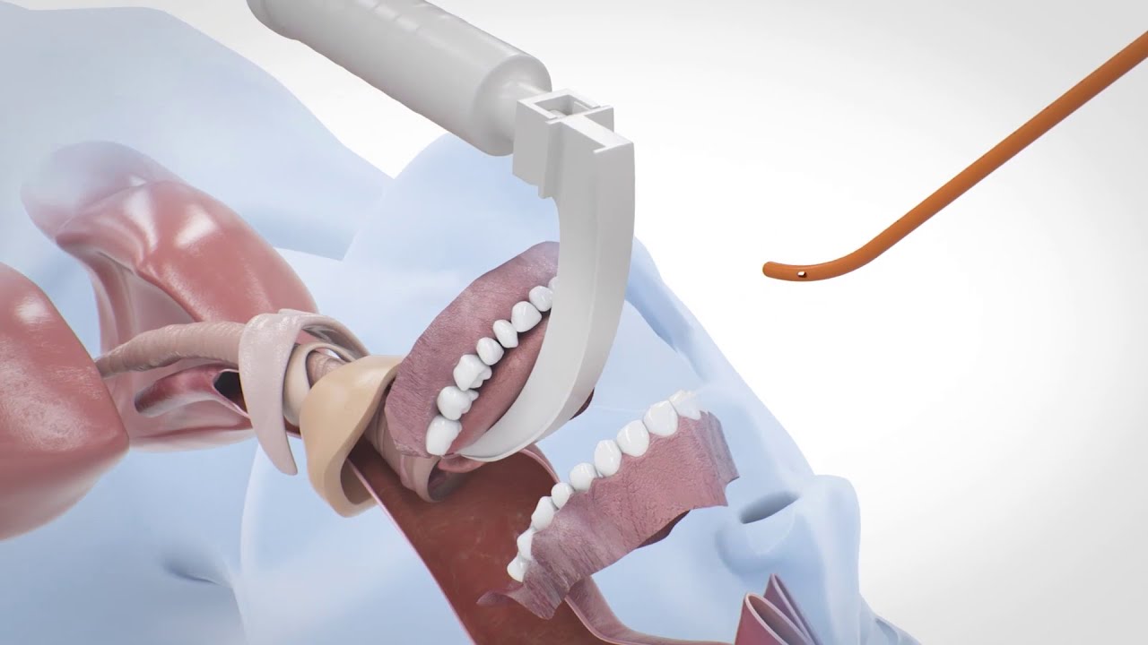 i-Bougie Intubationshilfe