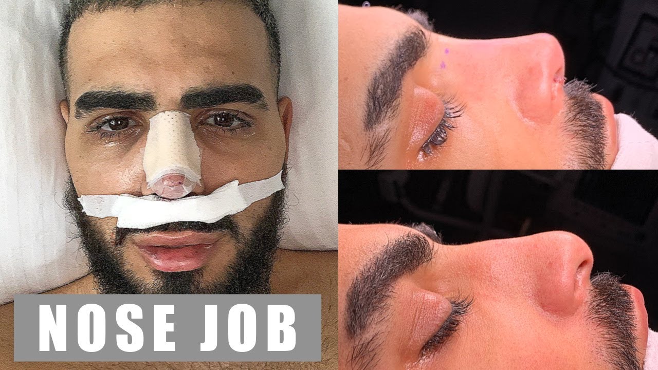 I got my first nose job in turkey!