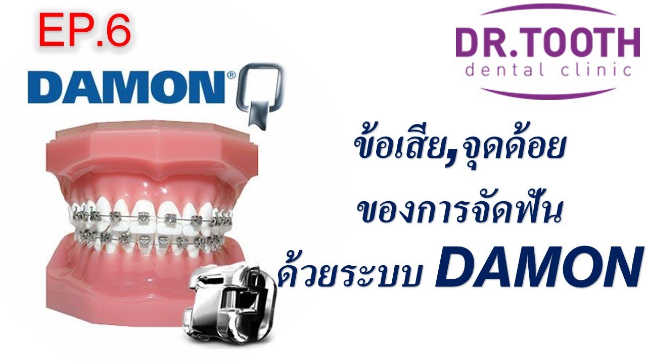 5 ข้อเสีย, จุดด้อยของการจัดฟันด้วยเดม่อน (DAMON) EP. 6 #จัดฟันที่ไหนดี #ตัดฟันเดม่อน