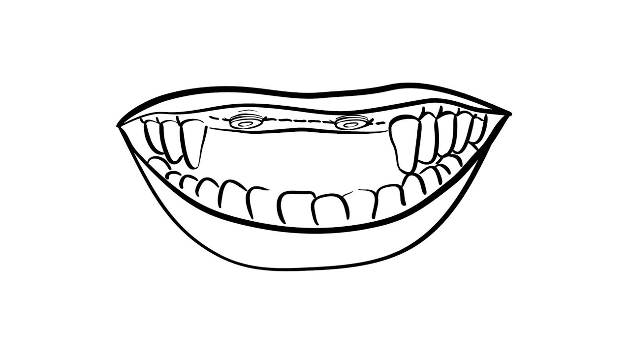 Hybridge Dental Implants - Upper Multiple Teeth Process