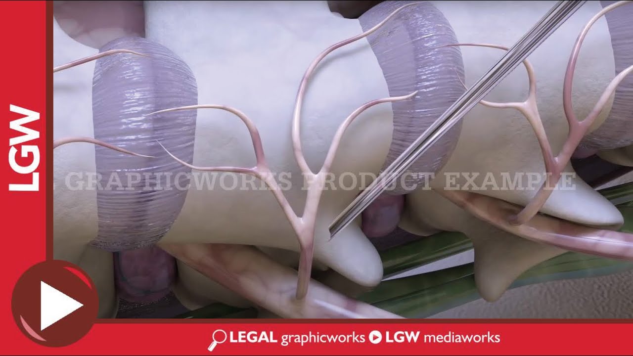 Cervical Rhizotomy Surgery Animation