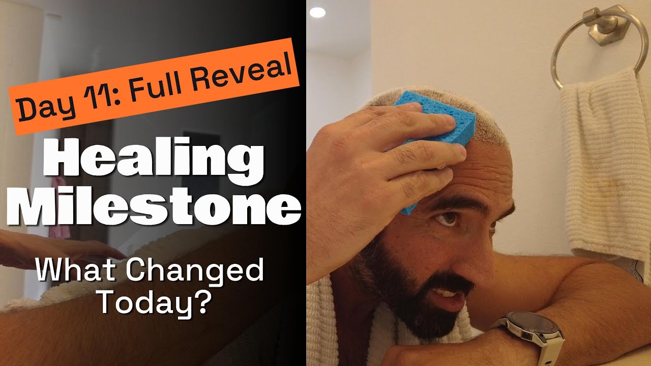 I Finally Washed My New Hair (Day 11 Hair Transplant Reveal)