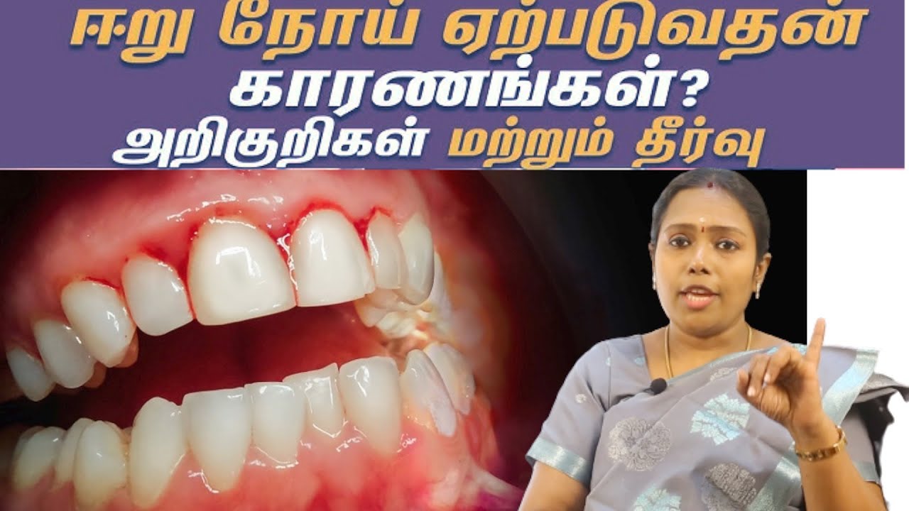 பல் ஈறுகளில் இரத்தம் வர காரணம்... | home remedy for teeth bleeding |Dr.Rajalakshmi | TCH HOSPITAL