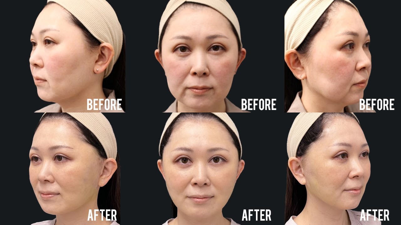【フェイスリフト】たるみとしわが本当になくなった！【ビフォーアフター】