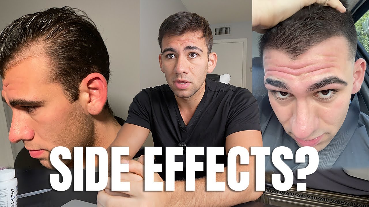 6 MONTHS ON FINASTERIDE - MY EXPERIENCE