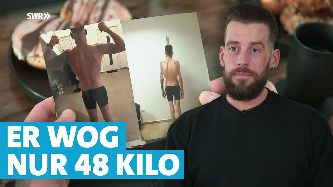 Magersucht: Krankheit kostete Thomas fast das Leben