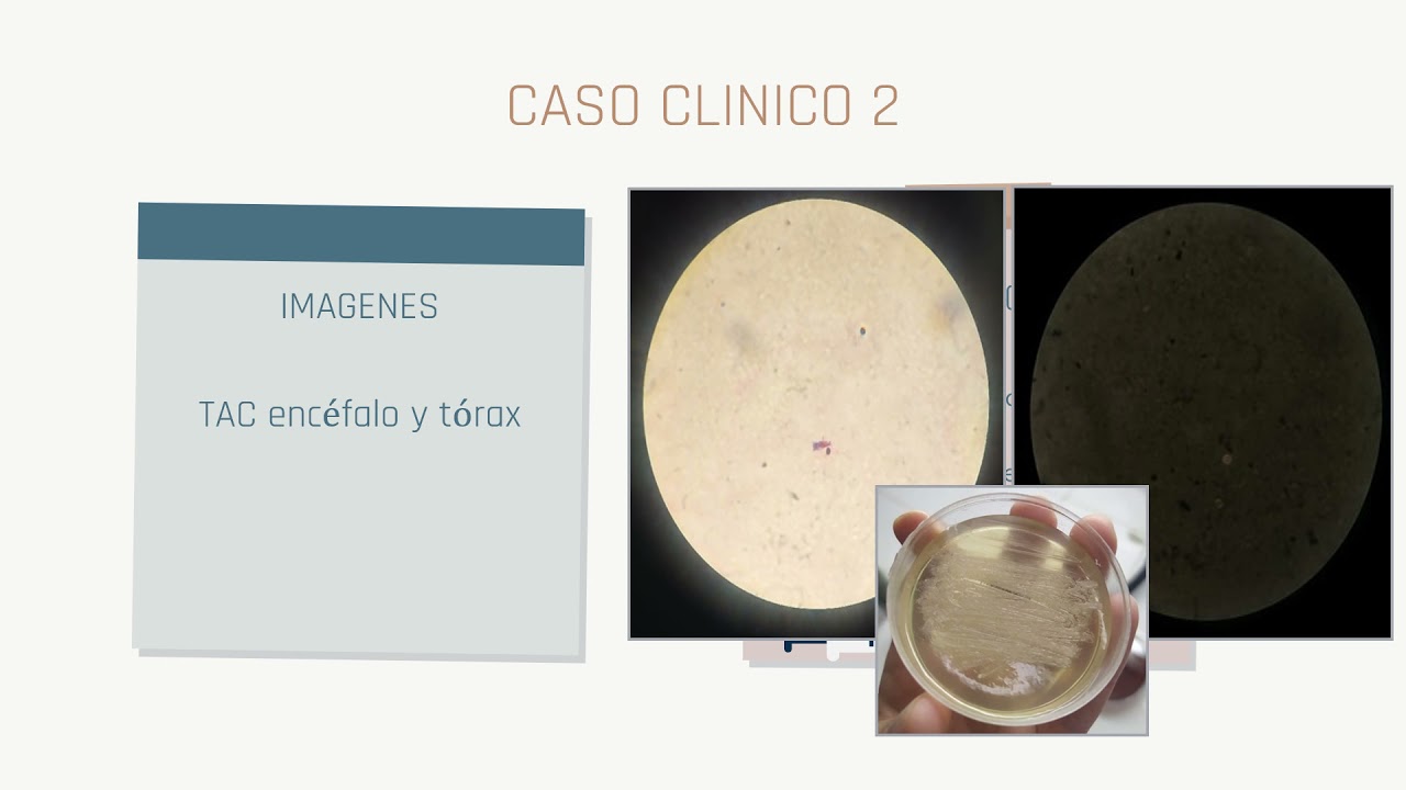 Ateneos Marzo 2021: Abordaje de las infecciones oportunistas en el paciente con HIV