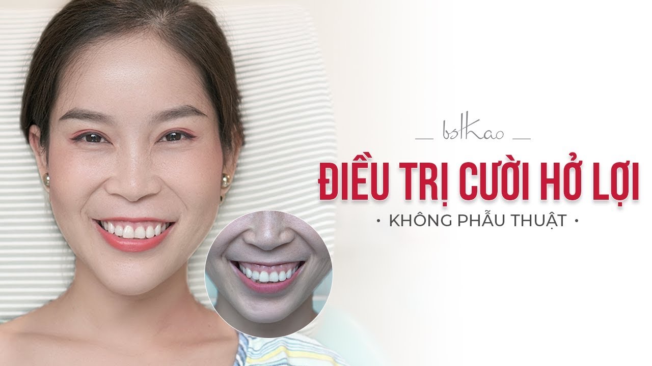 [Bác sĩ Thảo] ĐIỀU TRỊ CƯỜI HỞ LỢI KHÔNG PHẪU THUẬT NHƯ THẾ NÀO?