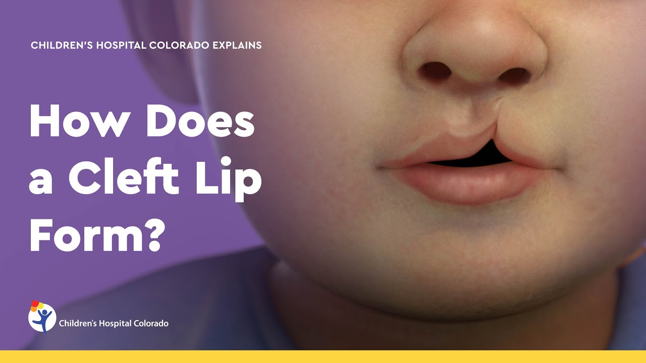 How Does a Cleft Lip Form?