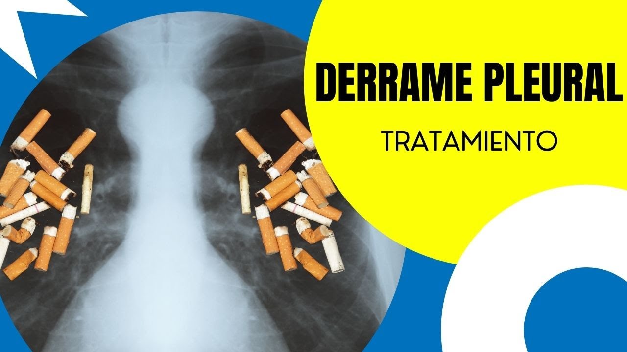 Tratamiento Derrame Pleural (Líquido en la pleura)