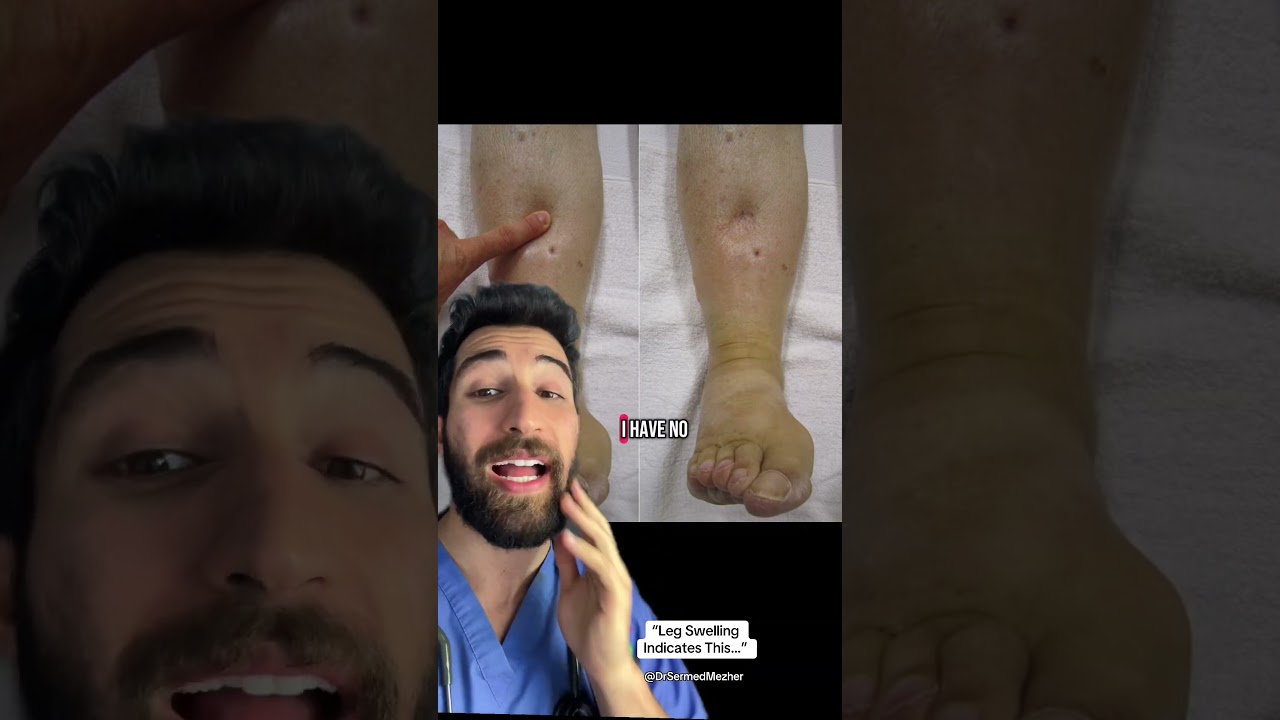 &ldquo;Swelling of the Legs Means This&hellip;&rdquo; #what