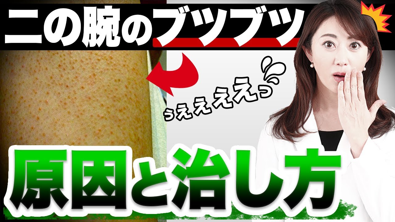 二の腕にできるぶつぶつ(毛孔性苔癬)😨😨原因・治し方・市販薬・市販クリーム・生活習慣で気を付けることを皮膚科医が皮膚科の治療について徹底解説