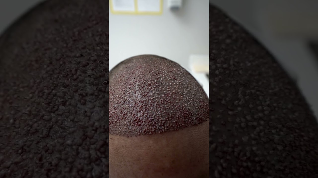 Hair Transplant procedure with 3000 grafts. Before & After  | Care4Hair