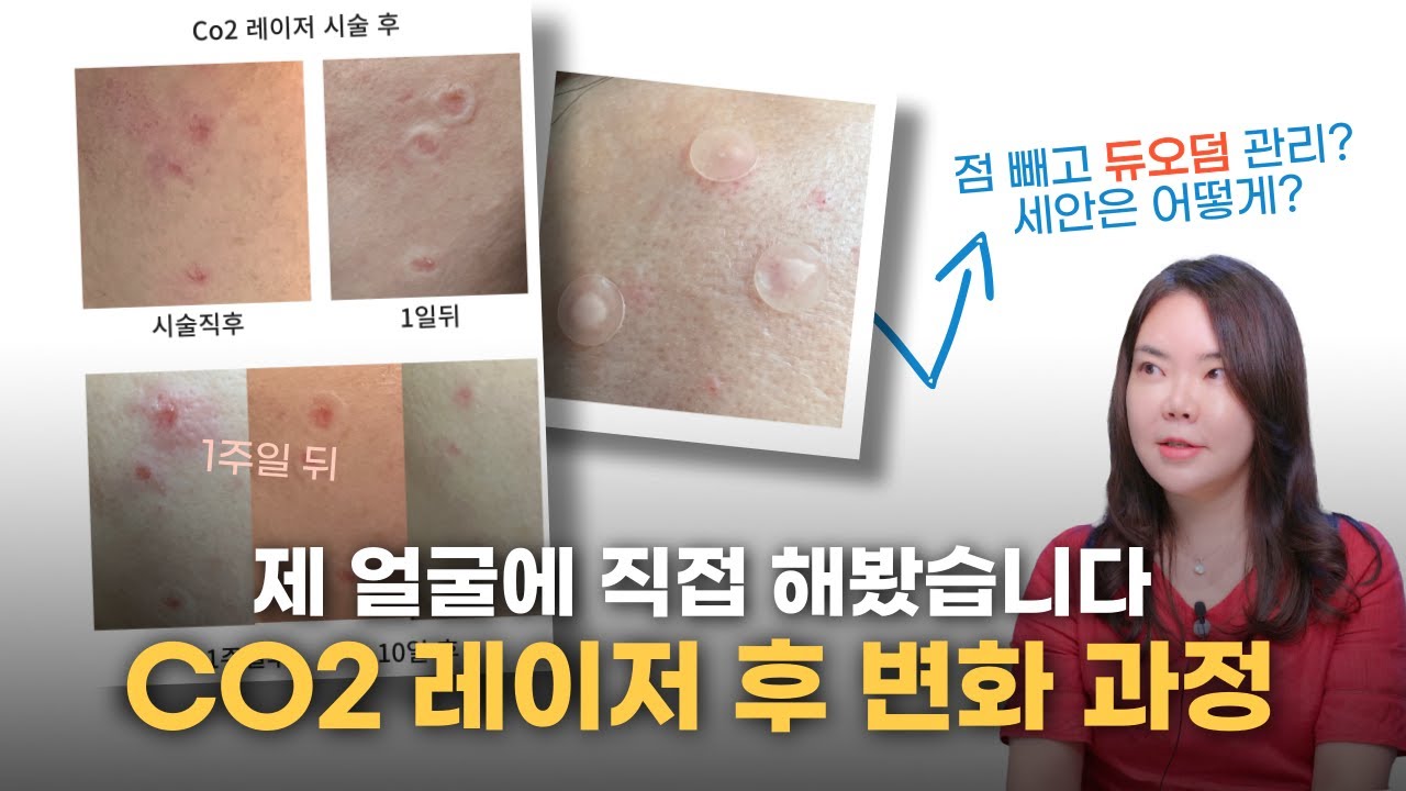 CO2 레이저 시술 후 피부 변화 과정 직접 보여드립니다. 듀오덤 관리 가장 많이 물어보시는 질문들까지!