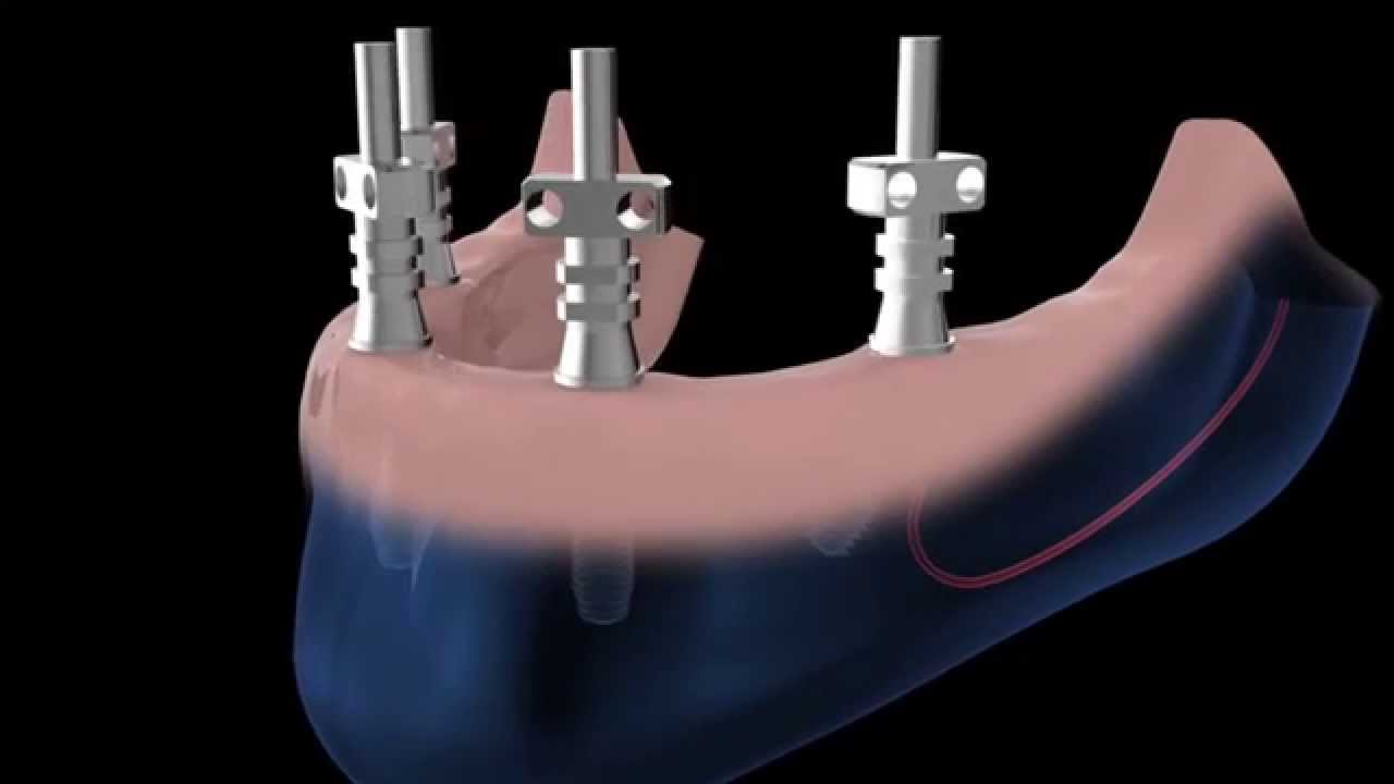 Bone System Easy-on-Four