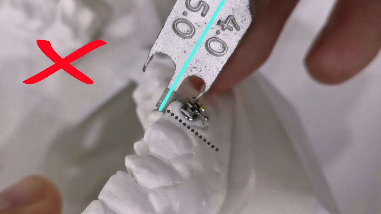 Bracket positioning, braces placement using height gauge