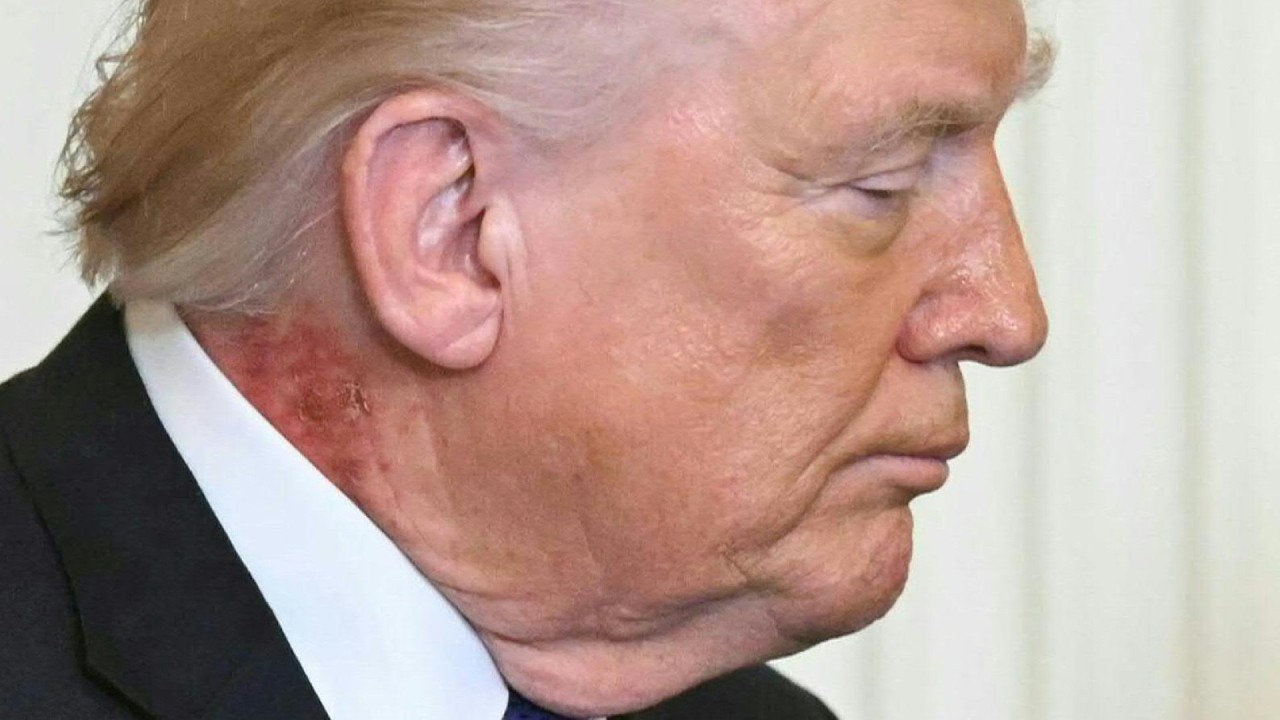 Ausschlag an Trumps Hals sorgt für neue Spekulationen