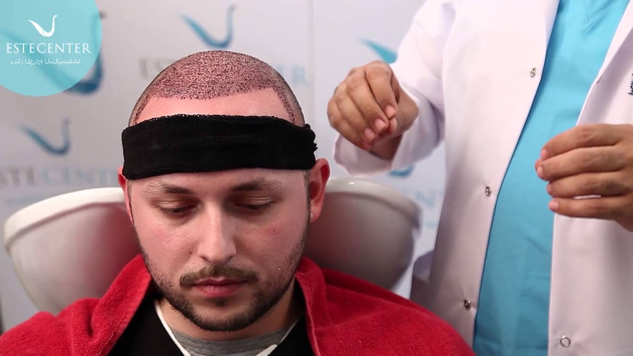 لبس قبعة بعد زراعة الشعر