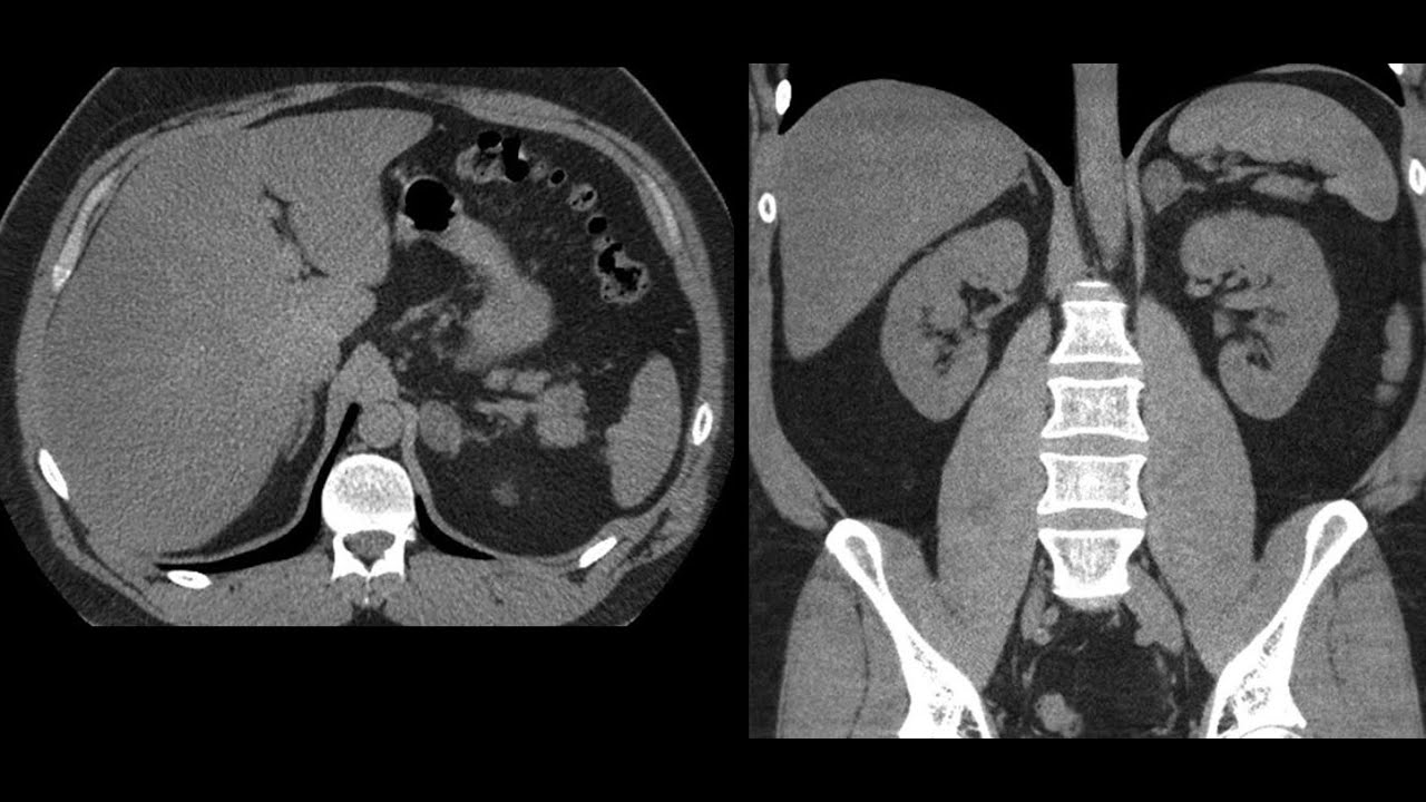 adenoma adrenal, avaliação pela TC