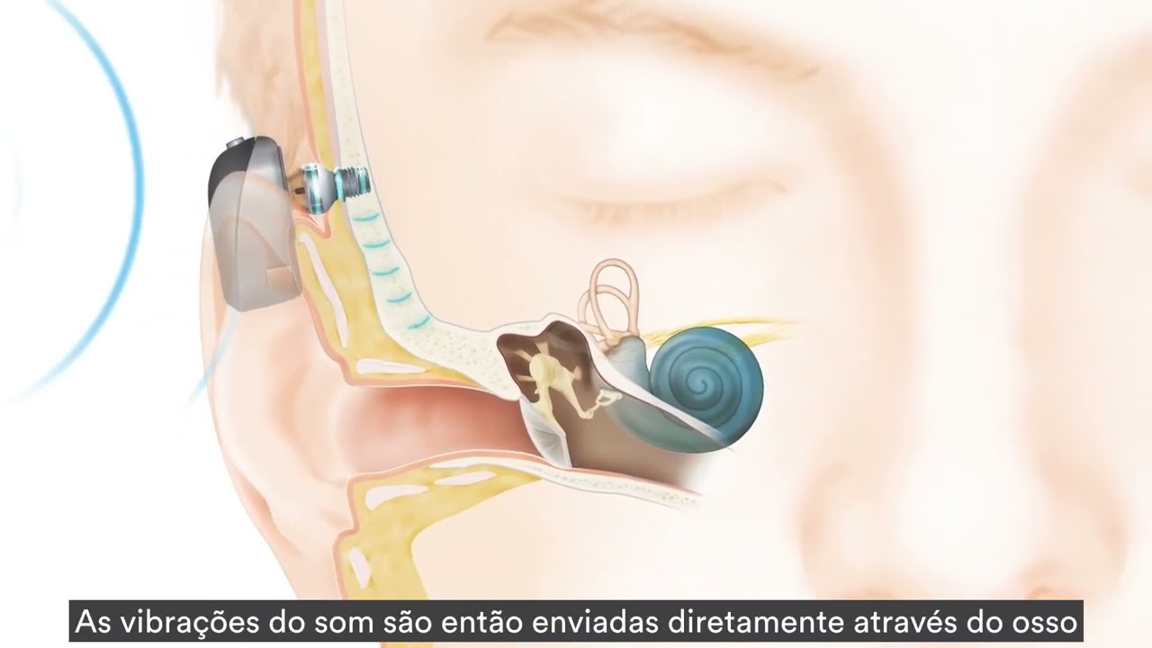 Como o Sistema Baha® Connect funciona?