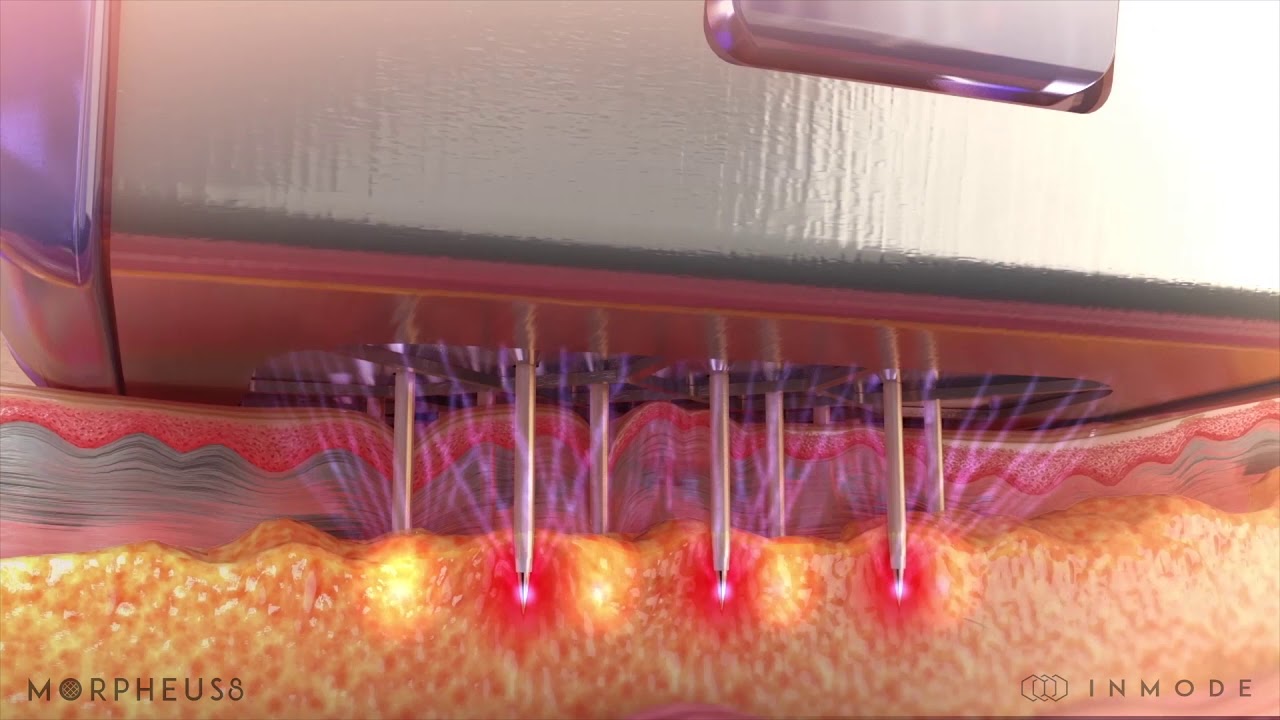 Morpheus8 Radiofrequency Microneedling