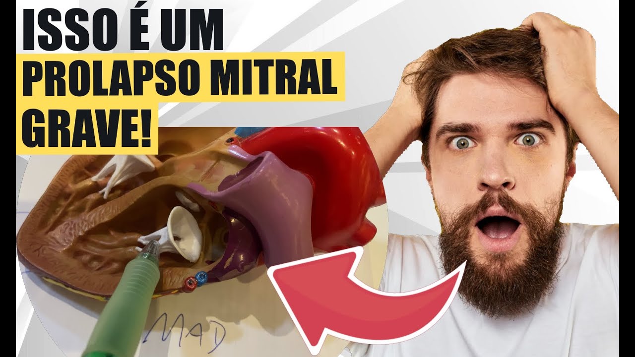Identifique voce mesmo se seu prolapso mitral é grave