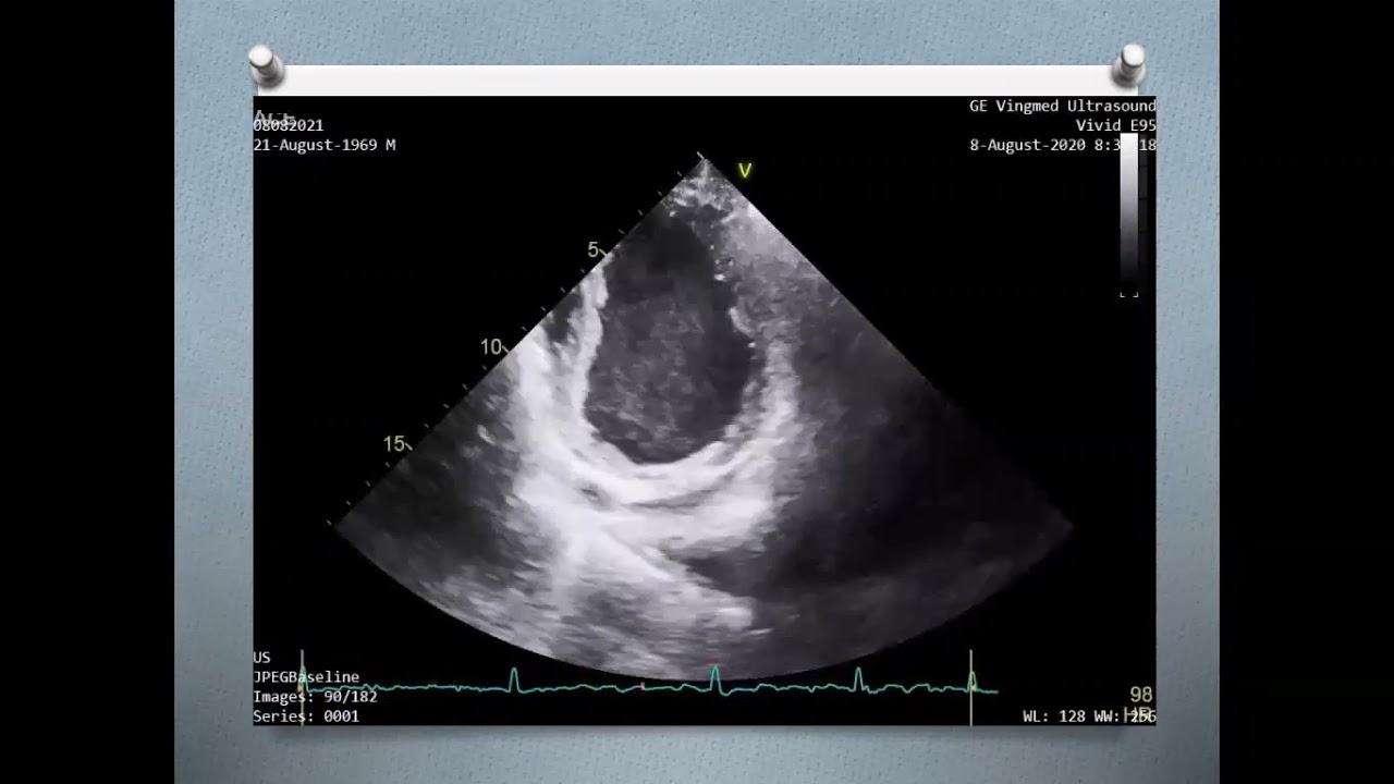 Assessment of Mitral paravalvular leak