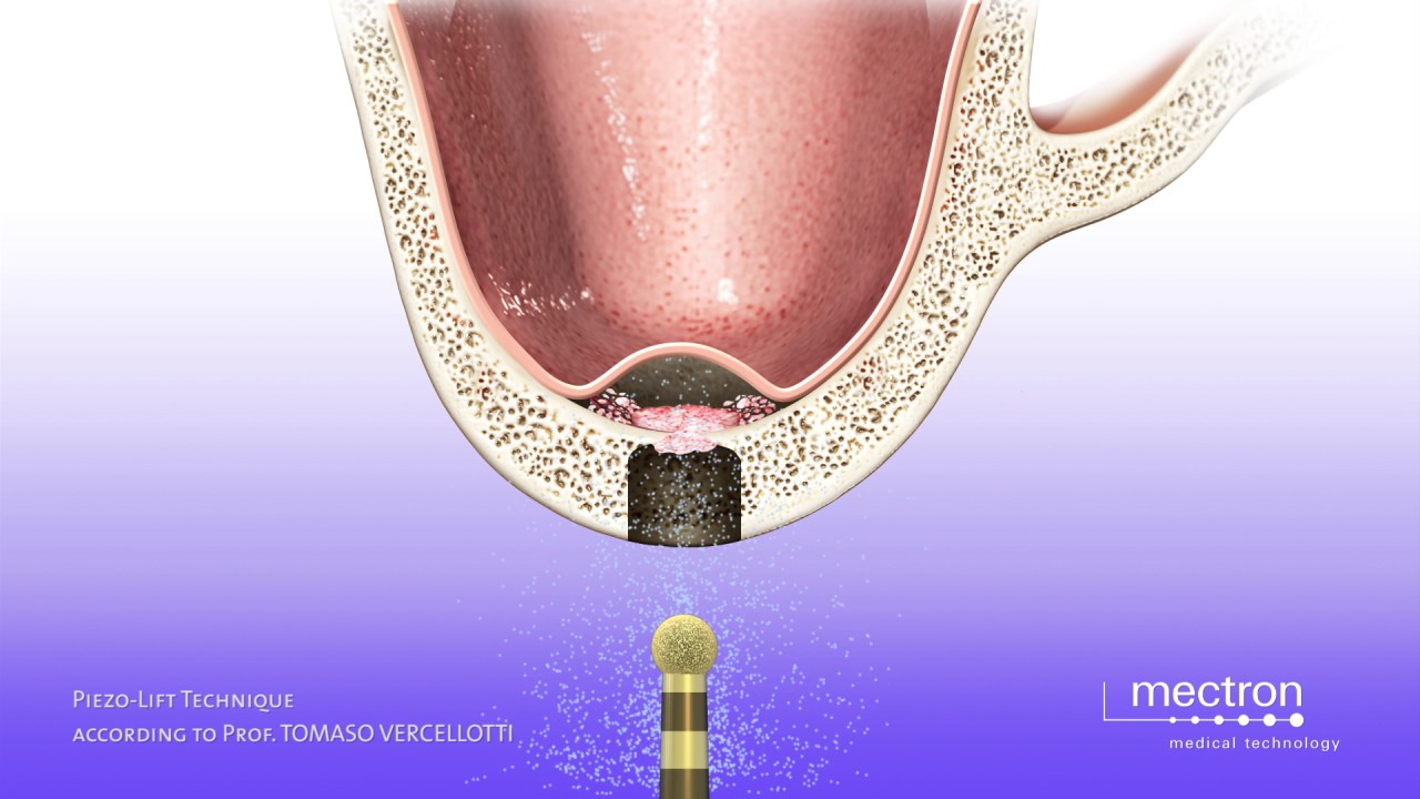 PIEZOSURGERY - Prof. Tomaso Vercellotti - Sinus lift with crestal approach - Piezo-Lift technique