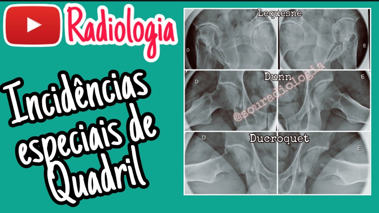 20- Incidências Radiológicas para  Impacto femoroacetabular (Radiologia)