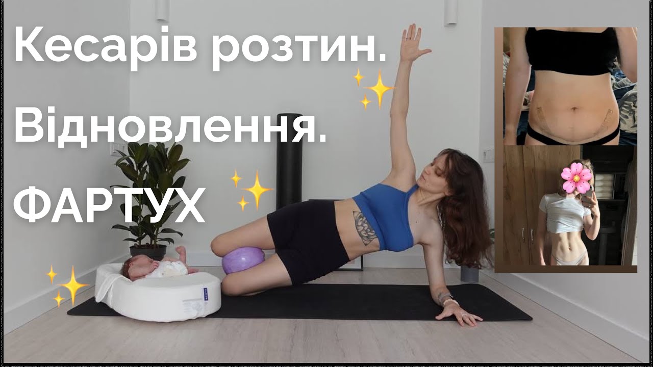 ФАРТУХ. Шрам після кесаревого. Як відновитись після КР