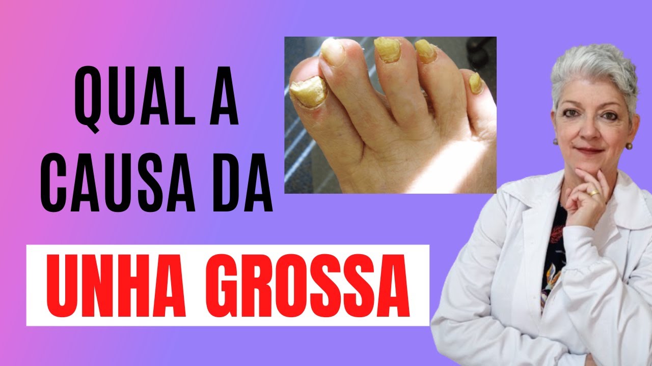 Saiba quais são as Causas da UNHA GROSSA