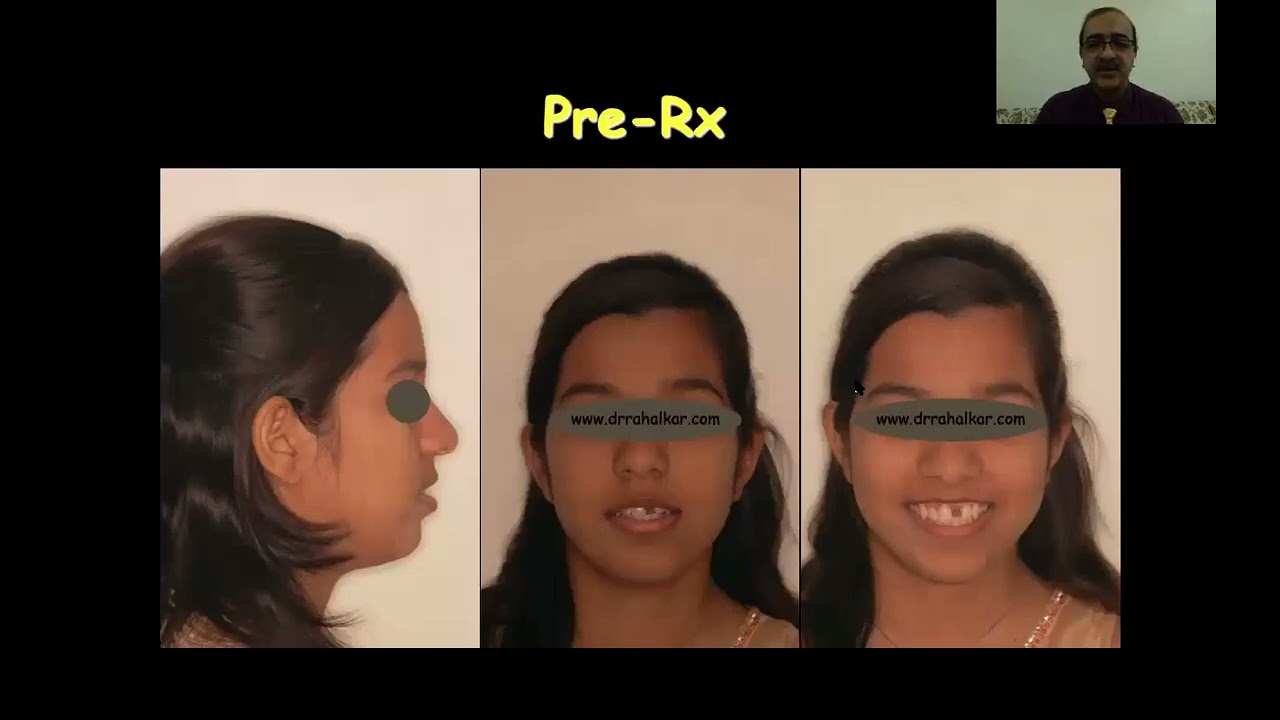 Jayesh S  Rahalkar - Contemporary Orthodontic Management of Loss of Maxillary Central Incisors
