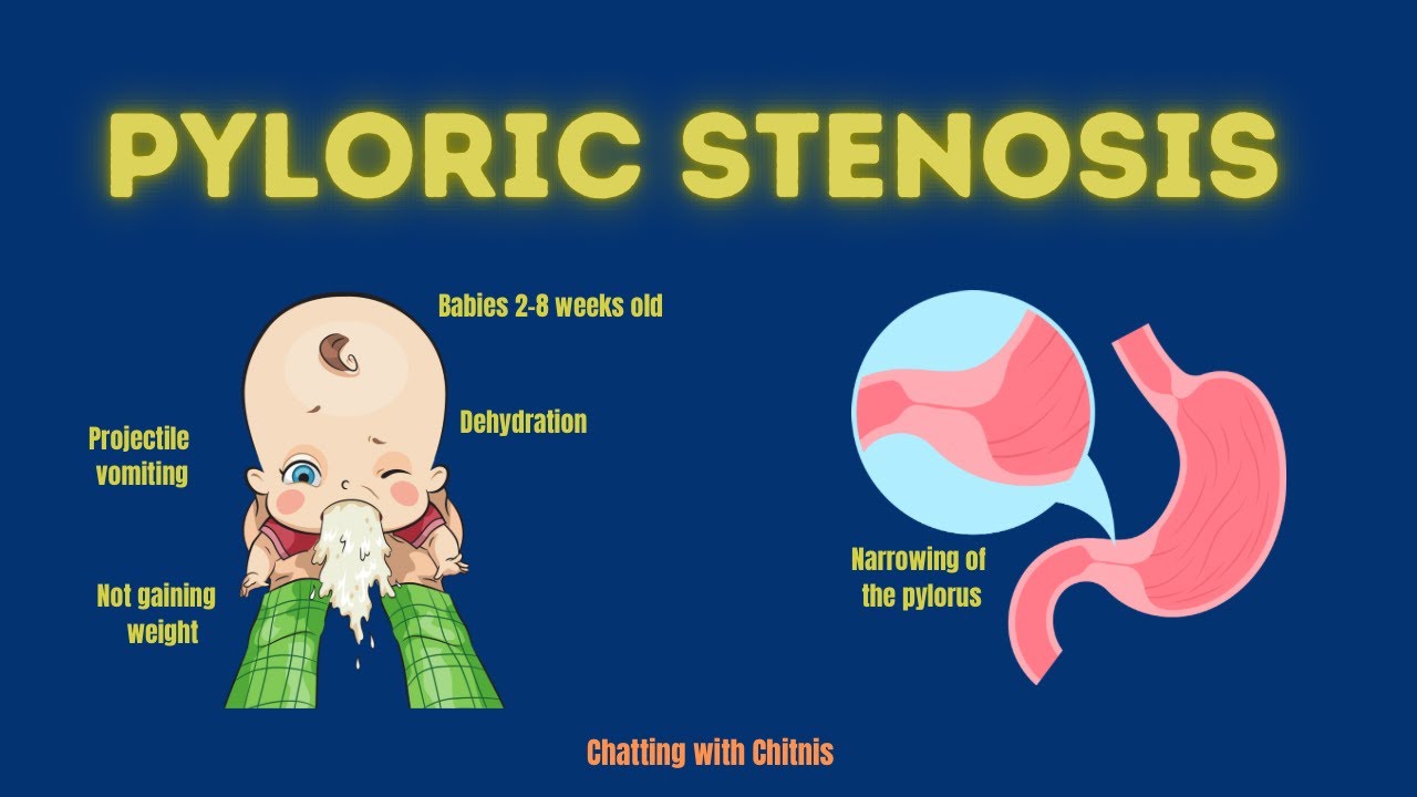 Pyloric stenosis