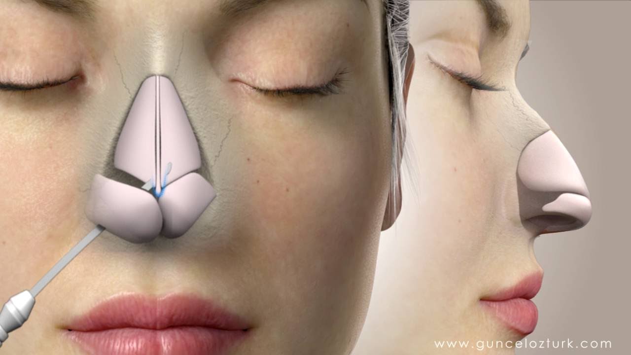 ¿Cómo se realiza las operaciónes de rinoplastia cerrada? Assoc.Prof.Dr. Guncel Ozturk,MD #DRGO
