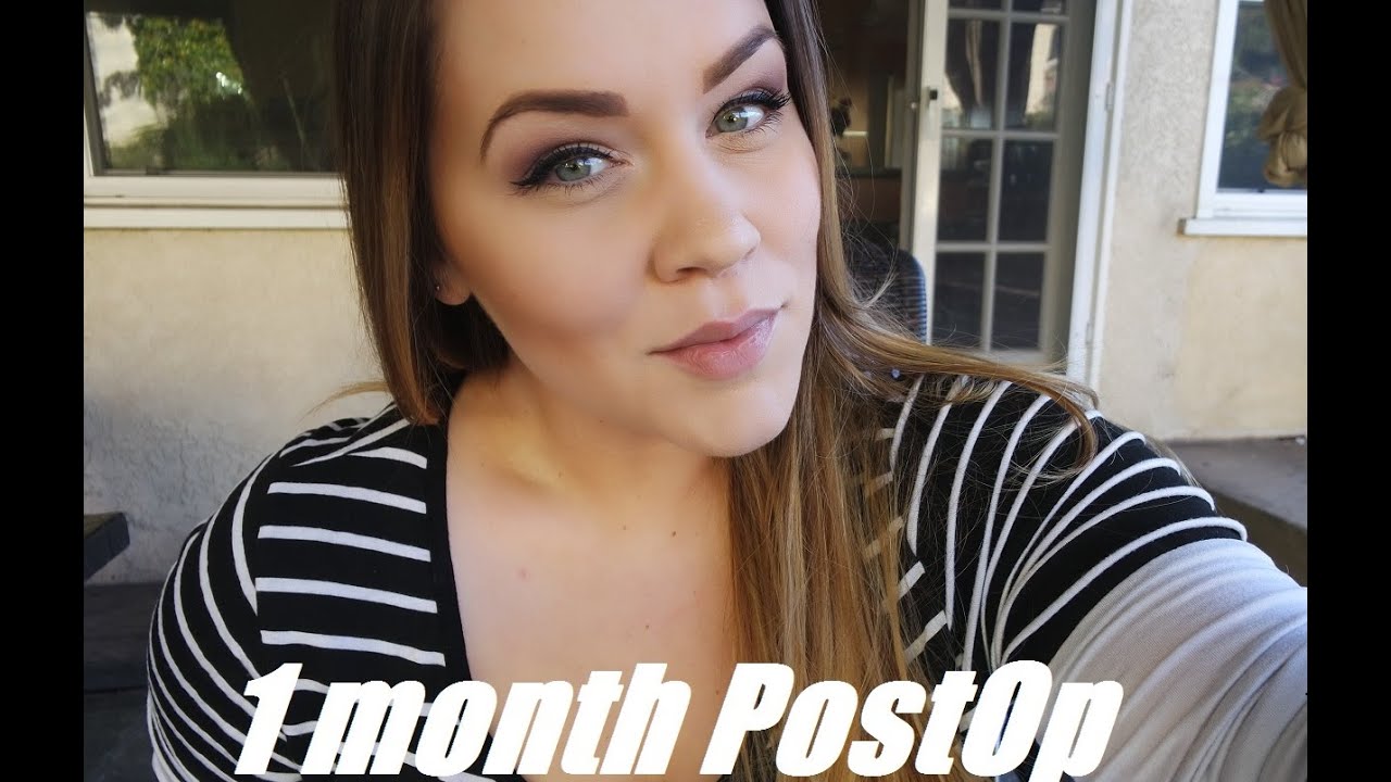 1 Month Post Op VSG Surgery - Before and Now Pics