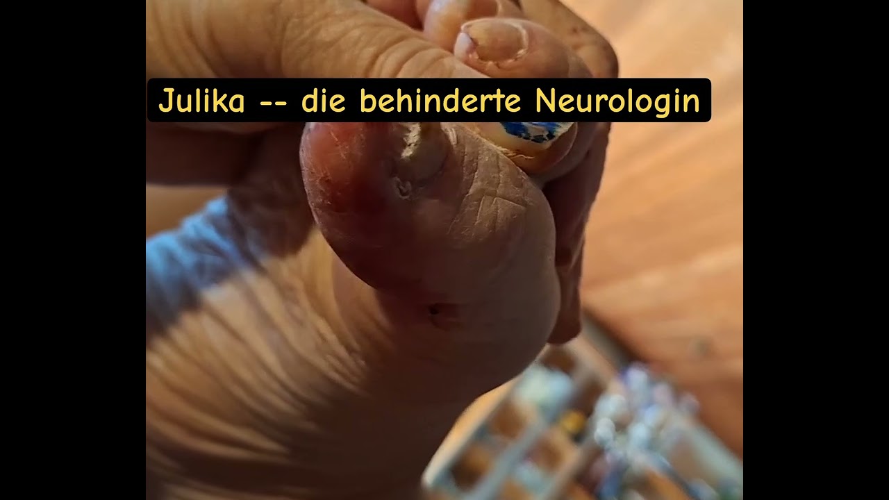 Verschärfte Pediküre bei meiner Nagel-Psoriasis Teil 2