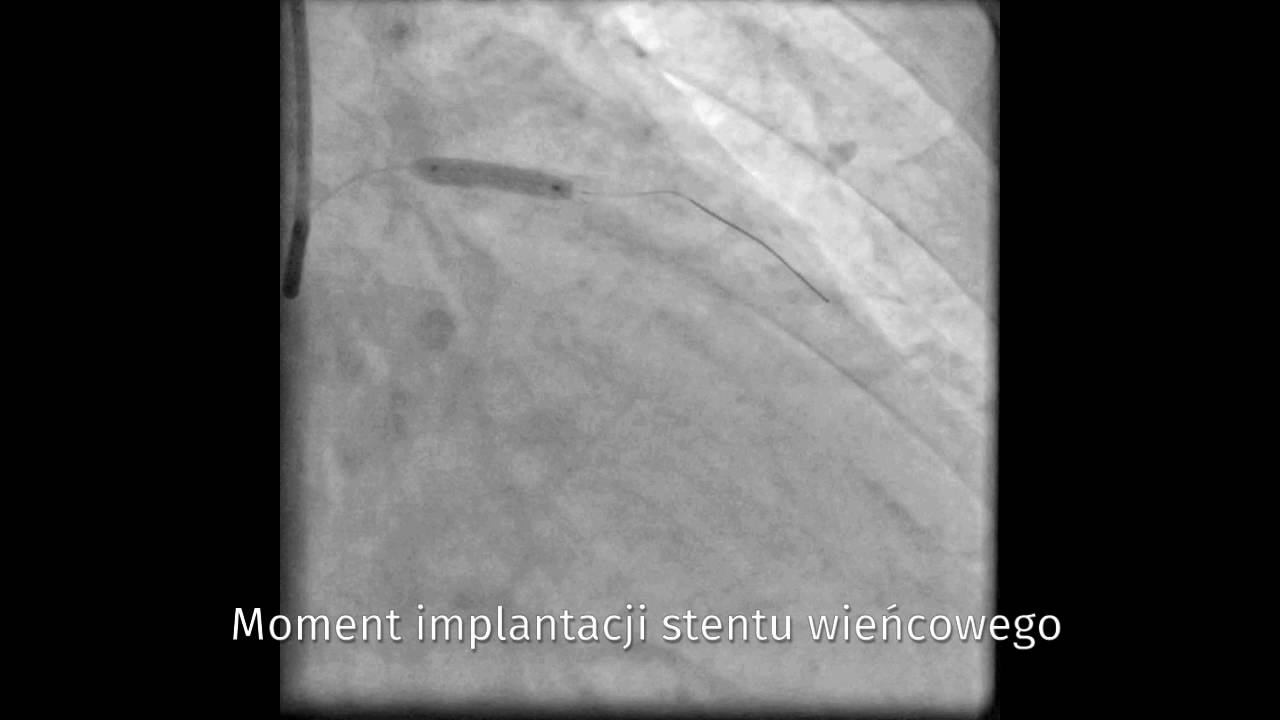 Angioplastyka: moment implantacji stentu wieńcowego