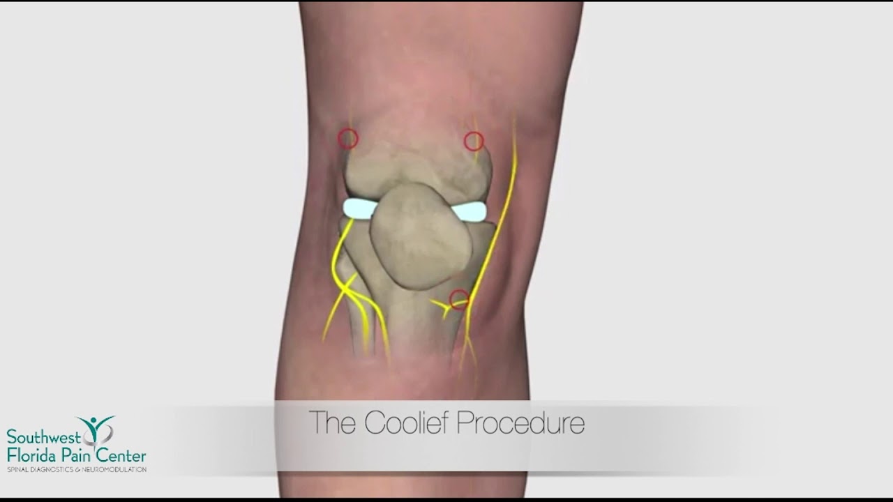 The Coolief® Procedure