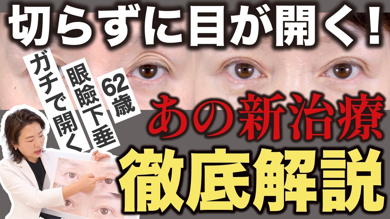 【切らない眼瞼下垂】まじで目が開く！美容外科医12年目のキム先生が絶賛の二重整形！【62歳症例解説】