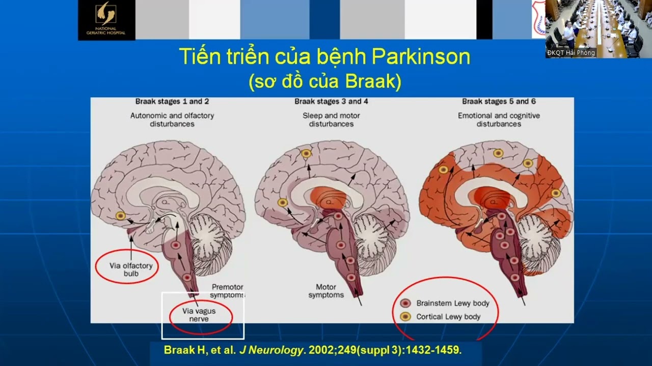 Cập nhật chẩn đoán và điều trị bệnh Parkinson