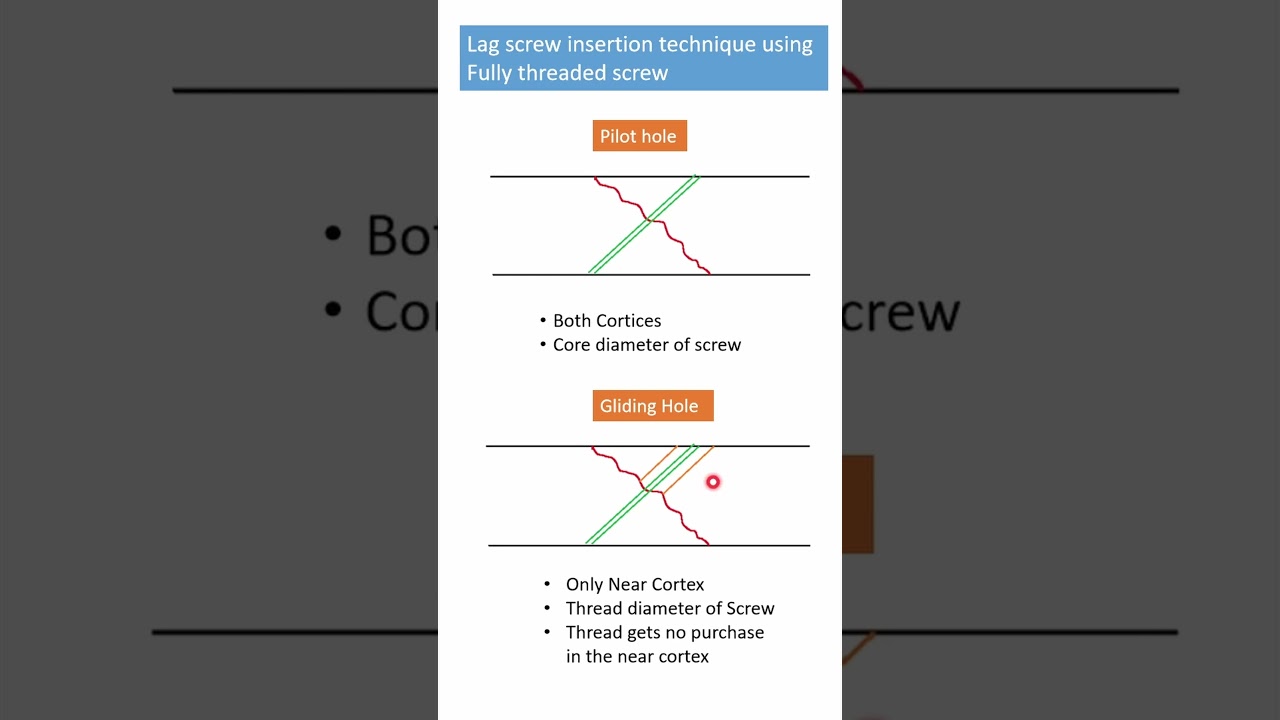 Lag screw insertion technique using fully threaded screw