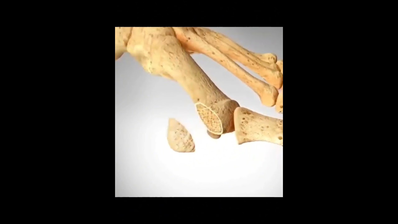 Cirug&iacute;a de JUANETE #osteopatia #fisio #fisioterapia #hallux #juanete