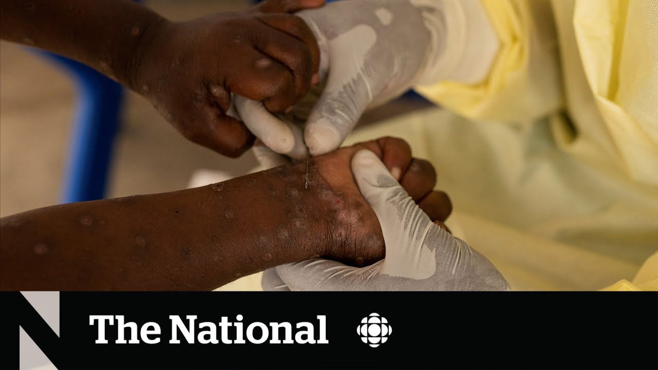 Mpox cases surge in Toronto as Africa declares a health emergency