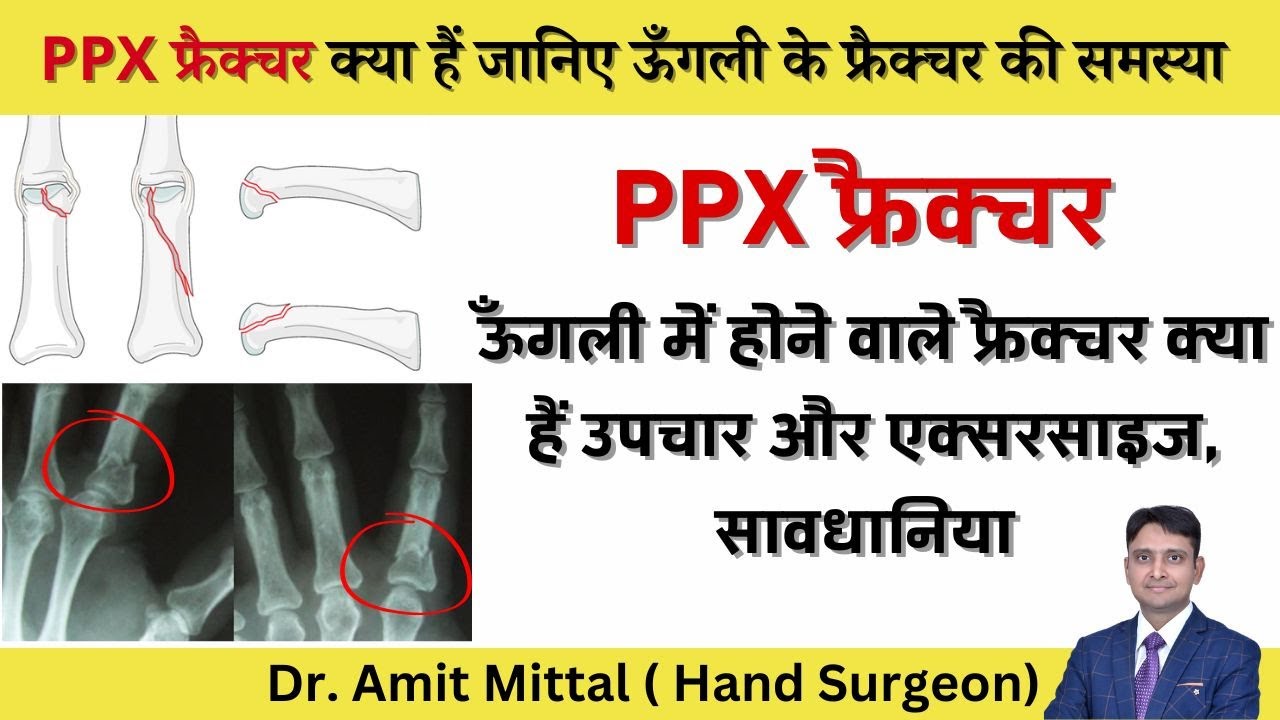 ऊँगली में होने वाले फ्रैक्चर क्या हैं उपचार और एक्सरसाइज, सावधानिया | PPX Fracture in Hindi