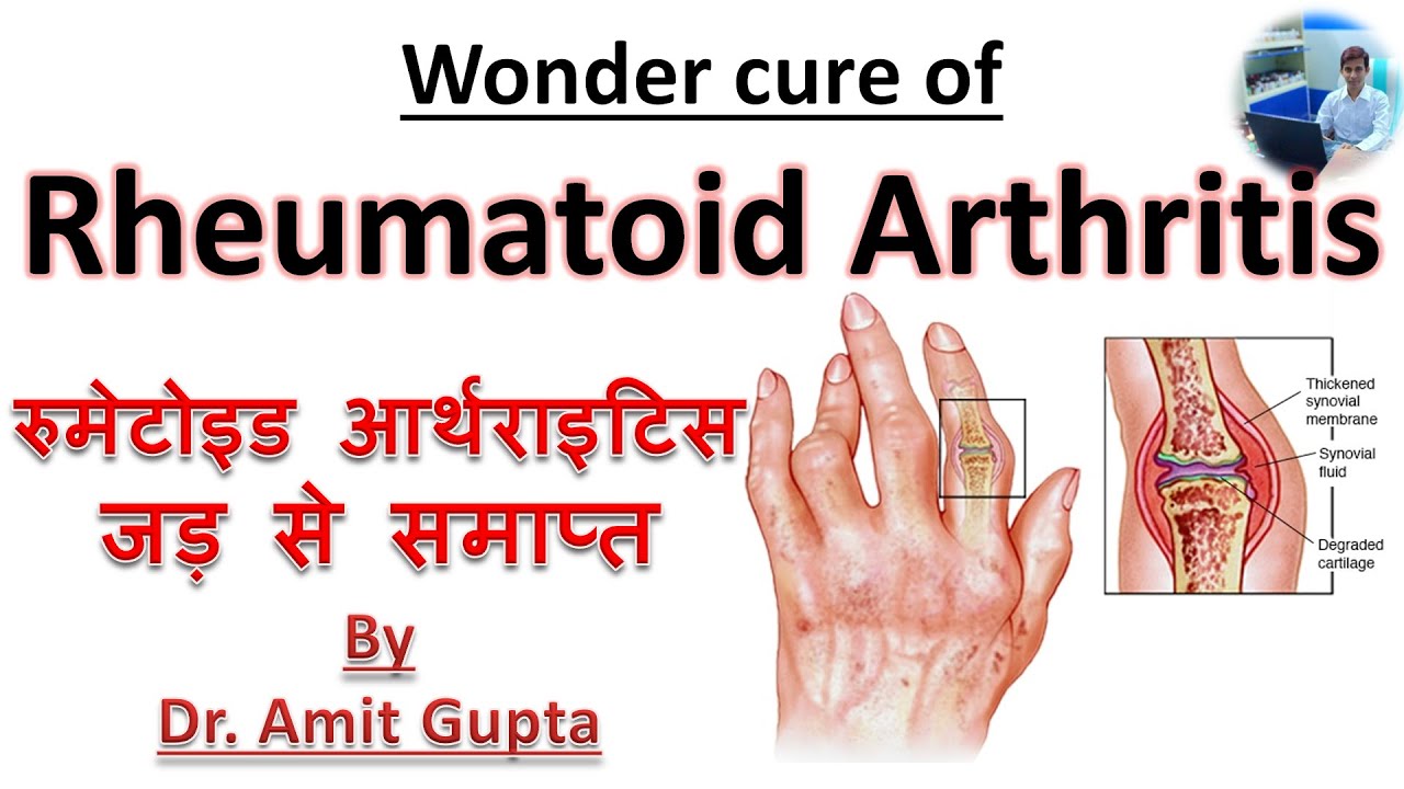 Rheumatoid arthritis cured case |Permanent cure of Rheumatoid arthritis||