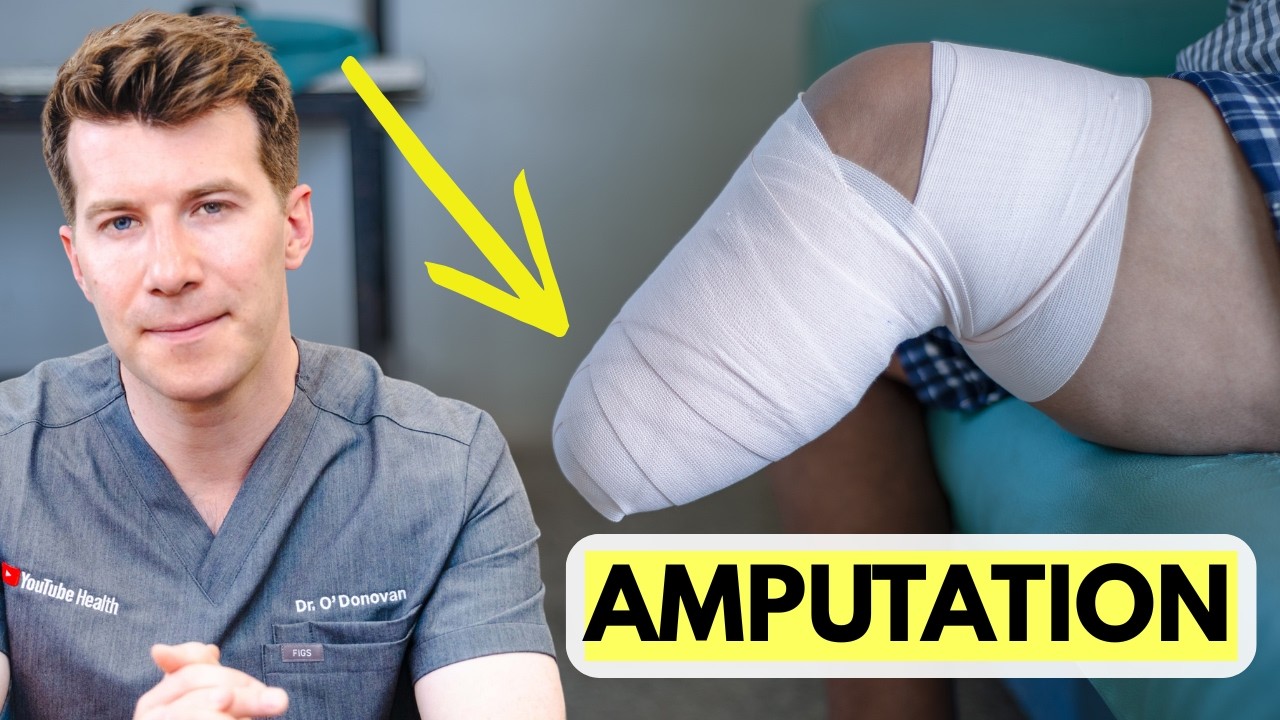 Doctor explains Limb Amputation | Procedure, recovery and more