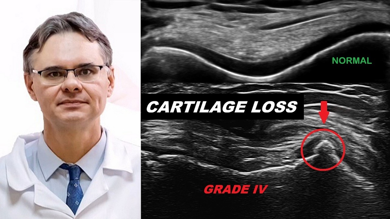 Knee Ultrasound: Articular Cartilage Pathologies (Chondromalacia, OCD, Chondrocalcinosis)