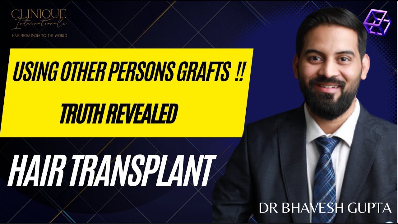 Can Hair Transplant be done from one person to another? Truth about using others graft in transplant